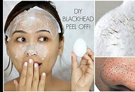 Image result for Skin Peels Blackhead Removal