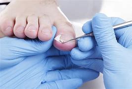 Image result for Keratin Debris Toenails