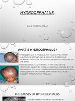 Image result for Hydrocephalus Concept Map