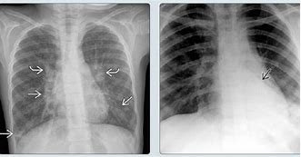 Image result for Asthma Chest X-Ray