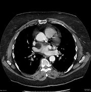 Image result for Interatrial Septum Lipomatous Hypertrophy Echo