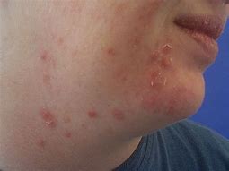 Image result for Papule Pimple