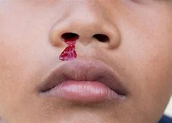 Image result for African Nose Bleed