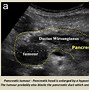 Image result for Spleen Infarction Ultrasound