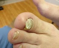 Image result for Keratin Debris Toenails