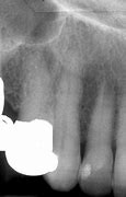 Image result for Maxillary Canine Pulp