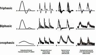 Image result for Nonphasic Venous Flow