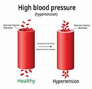 Image result for High Blood Pressure Arteries