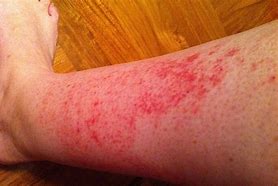 Image result for 10 Common Skin Rashes On Legs