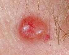 Image result for Raised Circular Lesion On Skin