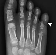 Image result for What Does a Dislocated Pinky Look Like