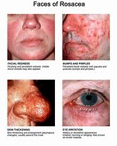 Image result for Rosacea Mites On Face