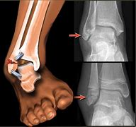 Image result for Stress Fracture Ankle Look Alike