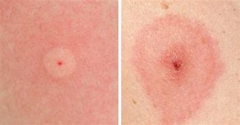 Image result for Different Bug Bites