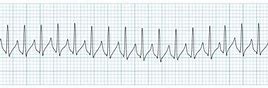 Image result for SVT vs Rapid AFib