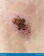 Image result for Knee Scab