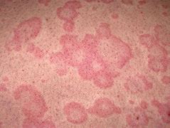 Image result for Swine Flu Rash