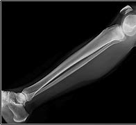 Image result for X-ray of Leg with Metal Plates