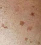 Image result for Dark Age Spots On Legs