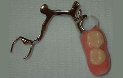 Image result for Metal-Based Partial Dentures