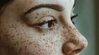 Image result for Eyelash Mites Symptoms