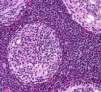 Image result for Neuropil Medulloblastoma