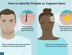 Image result for Boil vs Ingrown Hair