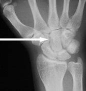 Image result for Capitate Bone Fracture Repair