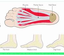 Image result for Plantarfasziitis