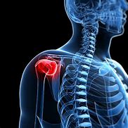 Image result for Third-Degree Dislocated Shoulder