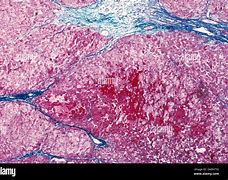 Image result for Adrenal Gland Adenoma