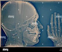 Image result for Bone Age Hand X-ray