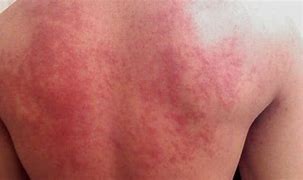 Image result for Peanut Butter Allergy Rash