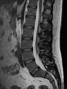 Image result for Lumbar Spine MRI 8Mm