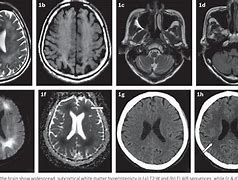 Image result for Toxic Leukoencephalopathy