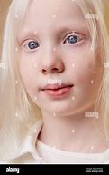 Image result for Albino Child