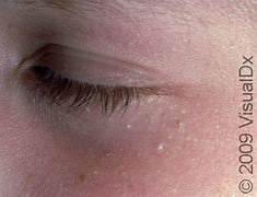 Image result for Flat Warts Under Eyes