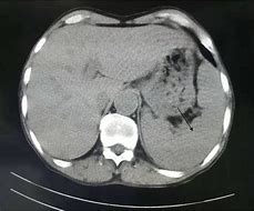 Image result for Spleen Enlargement CT