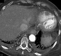 Image result for Left Atrial Appendage Thrombus On Toe