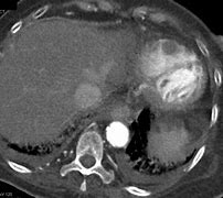 Image result for Cardiac CT Left Atrial Appendage Thrombus