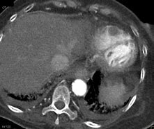 Image result for Atrleft Atrail Appendage Thrombus