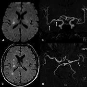 Image result for Brain MRI Angiogram