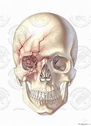 Image result for Skull Fracture