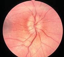 Image result for Papilledema