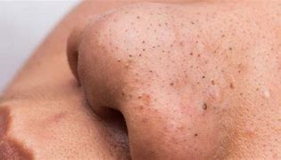 Image result for Alot of Pimples Black