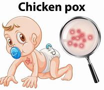 Image result for Pox Baby Shutterstock