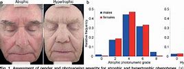 Image result for Atrophic Skin Aging