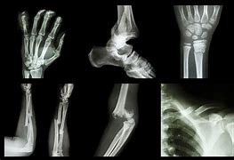 Image result for A Broken Bone