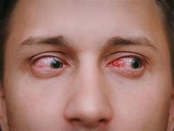 Image result for Symptoms of Eye Infection