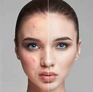 Image result for How to Get Rid Acne Bumps